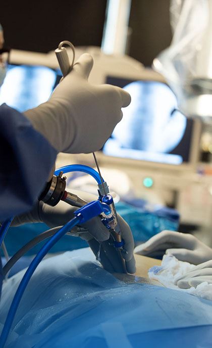 Endoscopic Rhizotomy